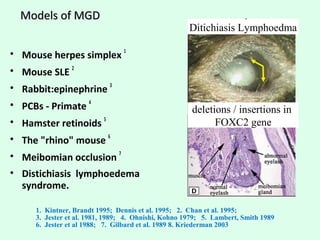 Meibomian Gland – PATHOLOGY
• Obstructive MGD leads to a progressive ductal
DILATATION and acinar ATROPHY

 