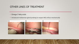 OTHER LINES OF TREATMENT
• Omega 3 fatty acids.
• Intraductal meibomian gland probing to reopen MG orfices mechanically
 