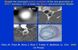 BAA 62 HU
DC
Despite the increasedDespite the increased spatial resolutionspatial resolution of the new generation ofof the new generation of
MDCTMDCT scanners,scanners, MRIMRI is better foris better for plaqueplaque characterization (Rabbitcharacterization (Rabbit
model)model)
Viles JF, Poon M, Sanz J, Rius T, Fuster V, Badimon JJ.Viles JF, Poon M, Sanz J, Rius T, Fuster V, Badimon JJ. Circ.Circ. 20042004
(In Press)(In Press)
 