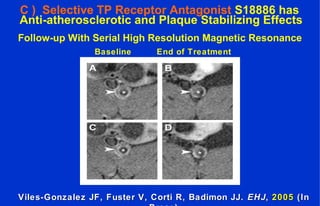 C ) Selective TP Receptor Antagonist S18886 has
Anti-atherosclerotic and Plaque Stabilizing Effects
Baseline End of Treatment
Follow-up With Serial High Resolution Magnetic Resonance
Viles-Gonzalez JF, Fuster V, Corti R, Badimon JJ.Viles-Gonzalez JF, Fuster V, Corti R, Badimon JJ. EHJEHJ,, 20052005 (In(In
 