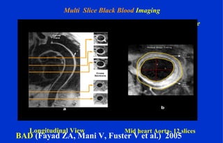 Longitudinal View
Ca++
BAD (Fayad ZA, Mani V, Fuster V et al.) 2005
Multi Slice Black Blood Imaging
Rapid Extended Coverage (REX) Turbo Spin Echo Technique
Mid heart Aorta- 12 slices
 
