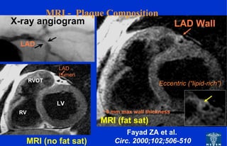 MRI (no fat sat)
MRI (fat sat)
LAD
Lumen
LV
RV
RVOT
LAD WallX-ray angiogram
LAD
~6 mm max wall thickness
Fayad ZA et al.
Circ. 2000;102;506-510
Eccentric (“lipid-rich”)
MRI - Plaque Composition
 