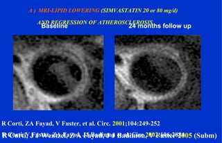 Baseline 24 months follow up
R Corti, J J Wentzel, Z A Fayad, J J Badimon, V Fuster 2005 (Subm)
A ) MRI-LIPID LOWERING (SIMVASTATIN 20 or 80 mg/d)
AND REGRESSION OF ATHEROSCLEROSIS
R Corti, ZA Fayad, V Fuster, et al. Circ. 2001;104:249-252
R Corti, V Fuster, ZA Fayad, JJ Badimon et al. Circ 2002;106:2884
 