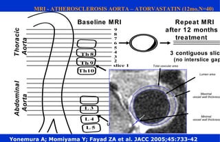 Abdominal
Aorta
Thoracic
Aorta Baseline MRI Repeat MRI
after 12 months
treatment
3 contiguous slice
(no interslice gap
Lower corner
of Th9
Upper corner
of L4
Total vascular area
Lumen area
Maximal
vessel wall thickness
Minimal
vessel wall thickness
Yonemura A; Momiyama Y; Fayad ZA et al. JACC 2005;45:733-42
MRI - ATHEROSCLEROSIS AORTA – ATORVASTATIN (12mo,N=40)
 