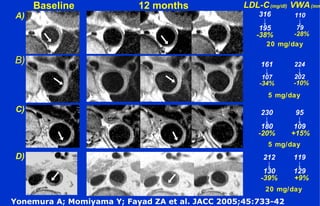 Baseline 12 months
A)
B)
LDL-C(mg/dl) VWA(mm
C)
D)
316
↓
195
-38%
161
↓
107
-34%
110
↓
79
-28%
224
↓
202
-10%
20 mg/day
5 mg/day
230
↓
180
-20%
212
↓
130
-39%
95
↓
109
+15%
119
↓
129
+9%
20 mg/day
5 mg/day
Yonemura A; Momiyama Y; Fayad ZA et al. JACC 2005;45:733-42
 