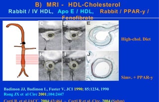 B) MRI - HDL-Cholesterol
Rabbit / IV HDL, Apo E / HDL, Rabbit / PPAR-y /
Fenofibrate
1
10
J.X. Rong et al. Circ 2001;104:2447
High-chol. Diet
Simv. + PPAR-y
Badimon JJ, Badimon L, Fuster V, JCI 1990; 85:1234, 1990
Rong JX et al Circ 2001;104:2447
 