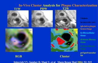 T2WPDWT1W
ClusterRGB
l
nc
iph
fc
lf
df
pvf
l
nc
iph
fc
lf
df
pvf
l-lumen
nc-necrotic core
iph-intra plaque
hemorrhage
fc-fibrocellular
tissue
df-dense fibrous
tissue
lf=loose fibrous
tissue
pvf-perivascular
fat
Itskovich VV, Samber D, Mani V, et al Magn Reson Med 2004; 52: 515
In-Vivo Cluster Analysis for Plaque Characterization
 