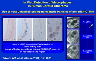 In Vivo Detection of Macrophages
in Human Carotid Atheroma
Use of Post-Ultrasmall Superparamagnetic Particles of Iron (USPIO) MRI
Pre-USPIO
Post-USPIO
24h
Post-USPIO
36h
Areas of USPIO accumulation (Pearls staining, b)
colocalizing with
areas of high macrophage content (MAC 387 stain, c)
in the fibrous cap region
Trivedi AR et al. Stroke 2004; 35: 1631
 