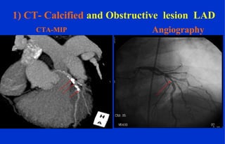 AngiographyCTA-MIP
1) CT- Calcified and Obstructive lesion LAD
 
