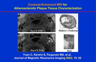 Contrast-Enhanced MRI for
Atherosclerotic Plaque Tissue Characterization
Yuan C, Kerwin S, Ferguson MS, et al.
Journal of Magnetic Resonance Imaging 2002; 15: 62
 