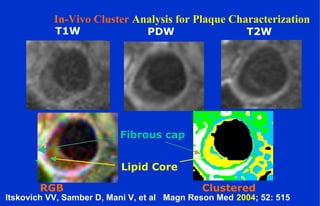 T1W PDW T2W
RGB
Fibrous cap
Lipid Core
Clustered
Itskovich VV, Samber D, Mani V, et al Magn Reson Med 2004; 52: 515
In-Vivo Cluster Analysis for Plaque Characterization
 