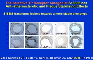 Actin
Actin
Macrophages
Macrophages
MMP-1
MMP-1
Endothelin-1
Endothelin-1
Apoptosis
Apoptosis
TPinhibitorControl
The Selective TP Receptor Antagonist S18886 has
Anti-atherosclerotic and Plaque Stabilizing Effects
S18886 transforms lesions towards a more stable phenotype
Viles-Gonzalez JF, Fuster V, Corti R, Badimon JJ.Viles-Gonzalez JF, Fuster V, Corti R, Badimon JJ. EHJEHJ,, 20052005 (In Press(In Press
 
