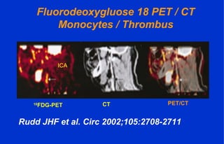18
FDG-PET CT PET/CT
Fluorodeoxygluose 18 PET / CT
Monocytes / Thrombus
Rudd JHF et al. Circ 2002;105:2708-2711
ICA
 