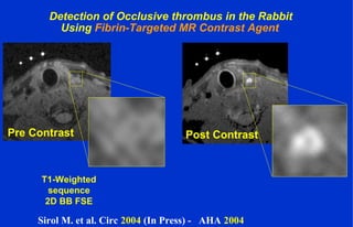 Detection of Occlusive thrombus in the Rabbit
Using Fibrin-Targeted MR Contrast Agent
Pre Contrast Post Contrast
T1-Weighted
sequence
2D BB FSE
Sirol M. et al. Circ 2004 (In Press) - AHA 2004
 