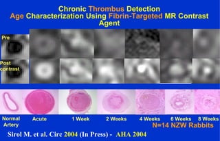 Chronic Thrombus Detection
Age Characterization Using Fibrin-Targeted MR Contrast
Agent
N=14 NZW Rabbits
Acute 1 Week 2 Weeks 4 Weeks 6 Weeks 8 WeeksNormal
Artery
Pre
Post
contrast
Sirol M. et al. Circ 2004 (In Press) - AHA 2004
 