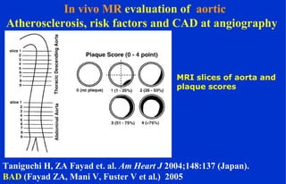 In vivo MR evaluation of aortic
Atherosclerosis, risk factors and CAD at angiography
MRI slices of aorta and
plaque scores
Taniguchi H, ZA Fayad et. al. Am Heart J 2004;148:137 (Japan).
BAD (Fayad ZA, Mani V, Fuster V et al.) 2005
 