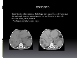 Meios de contraste na tomografia | PPTX
