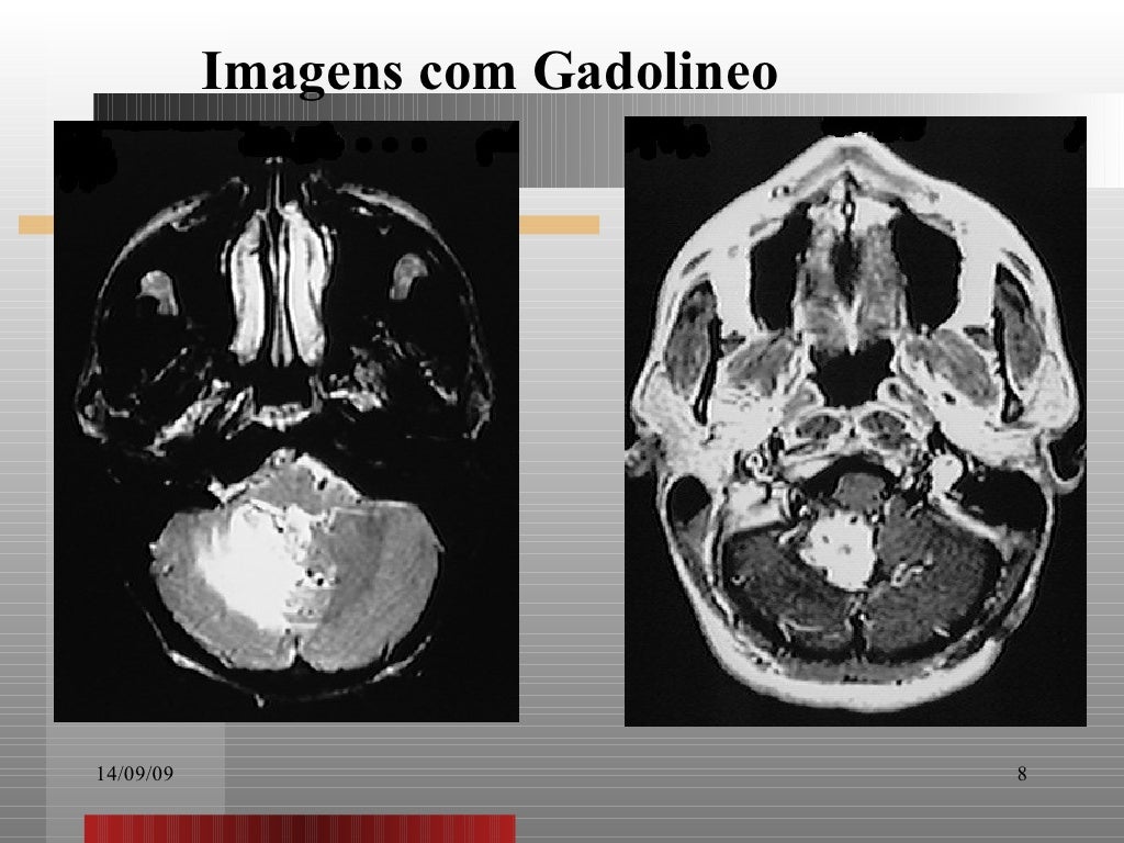 Meios De Contraste Ressonancia MagnéTica