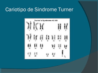 Cariotipo de Sindrome Turner 