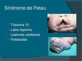 Síndrome de Patau Trisomía 13 Labio leporino Lesiones cardiacas Polidactilia 