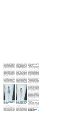 Diese vertikalen Schlitze am akti-     de am Arbeitsende der Spannhül-     stück fest umfasst, vorsichtig aus
ven Arbeitsteil-Ende ermöglichen       se das Fragment direkt in den Be-   dem Wurzelkanal gezogen wer-
hier ein Zusammenpressen, wo-          reich des Spannelements des         den (Abb. 12).
durch das Lumen dieses schma-          schmaleren Röhrchens weiter-           Wenn ein Wurzelkanalinstru-
len Röhrchens verengt werden           leiten (Abb. 7 und 8). Der Ex-      ment im Kanal stecken geblieben
kann (Spannelement).                   traktor wird nun aktiviert, indem   ist, kann es hilfreich sein, den Ex-
   Dieses schmale Röhrchen passt       das schmalere Röhrchen gegen        traktor mit leichtem Druck und
nun exakt in ein größeres, das eben-   den Widerstand der Feder wei-       einer Rotation gegen den Uhr-
falls einen Fixiergriff hat und des-   ter in die größere Spannhülse       zeigersinn aus dem Kanal zu zie-
sen innerer Durchmesser sich am        hineingeschoben wird (Abb. 9).      hen. Wenn das abgebrochene Wur-
anderen Ende verjüngt (Spann-          Das schmalere Röhrchen tritt nun    zelkanalinstrument (oder der Sil-
hülse, Abb. 6). Wenn der schma-        am Arbeitsende aus der Spann-       berstift) aus dem Kanal heraus-
lere Teil des Extraktors in den grö-   hülse heraus. Dabei werden die      gezogen worden ist, kann die nor-
ßeren gefügt ist, wird er von ei-      geschlitzten Teile des Spannele-    male endodontische Behandlung
ner Feder in der neutralen, nicht      mentes durch die Verjüngung in      sofort weitergeführt werden.
aktivierten Position gehalten.         der äußeren Spannhülse zusam-          Ein abgebrochenes Instrument
   Der Extraktor wird vorsichtig       mengedrückt und greifen so fest     tief im Wurzelkanal kann die en-
in den Zugangskanal eingeführt,        um das Metallfragment (Abb. 10      dodontische Behandlung kom-
                                                                           promittieren oder im schlimms-
                                                                           ten Fall zum Zahnverlust führen
                                                                           und wird in jedem Fall den Zahn-
                                                                           arzt und sein Team erheblich un-
                                                                           ter Stress setzen. Das Meitrac-
                                                                           System, ein speziell für das schnel-
                                                                           le, kontrollierte Entfernen gebro-
                                                                           chener Feilen und Silberstifte
                                                                           aus ansonsten unzugänglichen
                                                                           Lokalisationen entwickeltes En-
                                                                           do-Sicherheitssystem, macht die
                                                                           Instrumentenfraktur im Wurzel-
                                                                           kanal zu einem vorübergehenden
                                                                           Zwischenfall und lässt sie nicht
                                                                           zu einer fortdauernden Katastro-
Abb. 11: … und das Bruch-              Abb. 12: Mit dem Extraktor          phe werden.
stück lässt sich im Kanal si-          kann das Fragment nun aus              Dieses System, das die Ret-
cher greifen.                          dem Kanal entfernt werden.          tung eines Zahns auch nach In-
                                                                           strumentenfrakturen ermöglicht,
der durch den Trepan vorbereitet       und 11). Während der Druck ge-      ist ein sehr nützlicher Bestand-
wurde. Die Hohlfräsung um das          gen den Widerstand der Feder        teil im Instrumentarium eines
Fragment zentriert dieses auto-        aufrecht erhalten wird, kann der    jeden Zahnarztes.
matisch in den Extraktor, wobei        Extraktor, der mit dem kompri-      Dr. George Freedman,
                                                                                                                  DZW Ausgabe 36/2003
die konvergierenden inneren Wän-       mierten Spannelement das Bruch-     Toronto/Kanada                    s
 