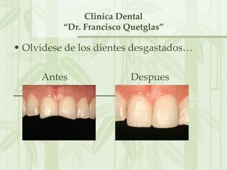 Clinica Dental
          “Dr. Francisco Quetglas”

• Olvidese de los dientes desgastados…

     Antes                Despues
 