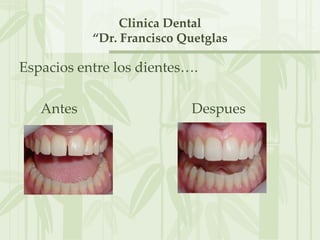 Clinica Dental
           “Dr. Francisco Quetglas

Espacios entre los dientes….

   Antes                   Despues
 