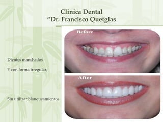 Clinica Dental
                     “Dr. Francisco Quetglas




Dientes manchados

Y con forma irregular,




Sin utilizar blanqueamientos
 