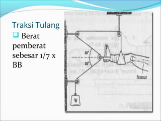 Traksi Tulang
 Berat

pemberat
sebesar 1/7 x
BB

 