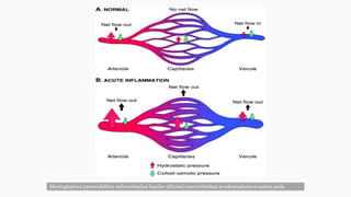 Meningkatnya permeabilitas mikrosirkulasi kapiler (filtrasi) menyebabkan terakumulasinya cairan pada
jaringan dan oedema
 