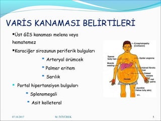 VARİS KANAMASI BELİRTİLERİ
Üst GİS kanaması melena veya
hematemez
Karaciğer sirozunun periferik bulguları
* Arteryal örümcek
* Palmer eritem
* Sarılık
 Portal hipertansiyon bulguları
* Splenomegali
* Asit kolleteral
07.10.2017 M. İYİYÜREK 5
 