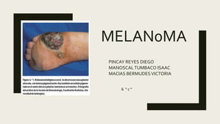 MELAN0MA
PINCAY REYES DIEGO
MANOSCALTUMBACO ISAAC
MACIAS BERMUDES VICTORIA
6 “ c “
 