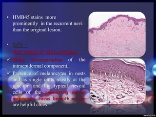 Hmb45 Melanocytic lesion of skin ( final) | PPTX