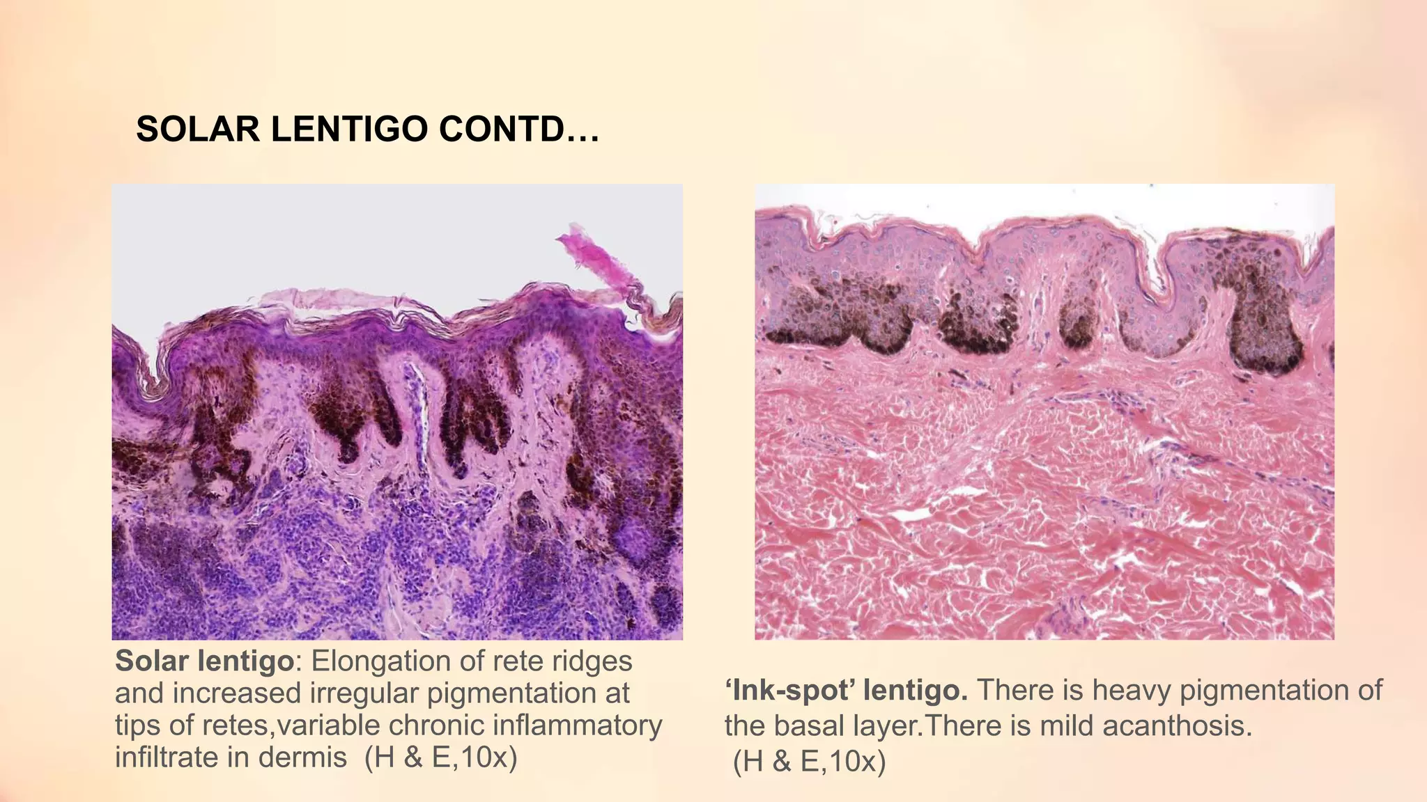 Melanocytic Lesions Pathology PPTX Melanocytic Lesions Pathology PPTX