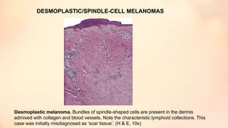 DESMOPLASTIC/SPINDLE-CELL MELANOMAS
Desmoplastic melanoma. Bundles of spindle-shaped cells are present in the dermis
admixed with collagen and blood vessels. Note the characteristic lymphoid collections. This
case was initially misdiagnosed as ‘scar tissue’. (H & E, 10x)
 