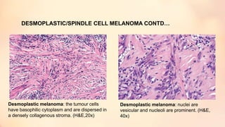 DESMOPLASTIC/SPINDLE CELL MELANOMA CONTD…
Desmoplastic melanoma: the tumour cells
have basophilic cytoplasm and are dispersed in
a densely collagenous stroma. (H&E,20x)
Desmoplastic melanoma: nuclei are
vesicular and nucleoli are prominent. (H&E,
40x)
 
