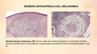 DESMOPLASTIC/SPINDLE-CELL MELANOMAS
(A) Neurotropic melanoma. (B) Tumour cells are loosely arranged in a concentric fashion
around a small nerve in the subcutis. Lymphocytes are present in the surrounding tissue. (H &
E)
 