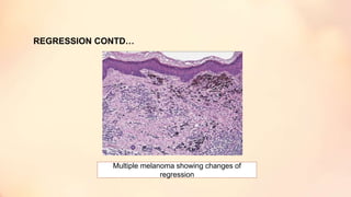 REGRESSION CONTD…
Multiple melanoma showing changes of
regression
 