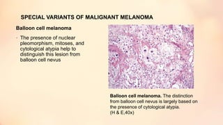 SPECIAL VARIANTS OF MALIGNANT MELANOMA
Balloon cell melanoma
• The presence of nuclear
pleomorphism, mitoses, and
cytological atypia help to
distinguish this lesion from
balloon cell nevus
Balloon cell melanoma. The distinction
from balloon cell nevus is largely based on
the presence of cytological atypia.
(H & E,40x)
 