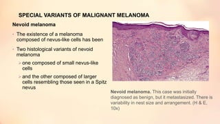 SPECIAL VARIANTS OF MALIGNANT MELANOMA
Nevoid melanoma
• The existence of a melanoma
composed of nevus-like cells has been
• Two histological variants of nevoid
melanoma
one composed of small nevus-like
cells
and the other composed of larger
cells resembling those seen in a Spitz
nevus
Nevoid melanoma. This case was initially
diagnosed as benign, but it metastasized. There is
variability in nest size and arrangement. (H & E,
10x)
 