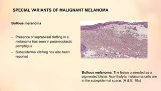 SPECIAL VARIANTS OF MALIGNANT MELANOMA
Bullous melanoma
– Presence of suprabasal clefting in a
melanoma has seen in paraneoplastic
pemphigus
– Subepidermal clefting has also been
reported
Bullous melanoma. The lesion presented as a
pigmented blister. Acantholytic melanoma cells are
in the subepidermal space. (H & E, 10x)
 