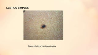 LENTIGO SIMPLEX
Gross photo of Lentigo simplex
 