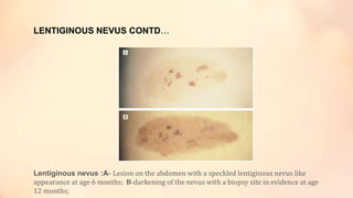 LENTIGINOUS NEVUS CONTD…
Lentiginous nevus :A- Lesion on the abdomen with a speckled lentiginous nevus like
appearance at age 6 months; B-darkening of the nevus with a biopsy site in evidence at age
12 months;
 