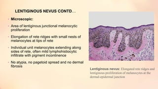 • Microscopic:
• Area of lentiginous junctional melanocytic
proliferation
• Elongation of rete ridges with small nests of
melanocytes at tips of rete
• Individual unit melanocytes extending along
sides of rete, often mild lymphohistiocytic
infiltrate with pigment incontinence
• No atypia, no pagetoid spread and no dermal
fibrosis
LENTIGINOUS NEVUS CONTD…
Lentiginous nevus: Elongated rete ridges and
lentiginous proliferation of melanocytes at the
dermal-epidermal junction
 