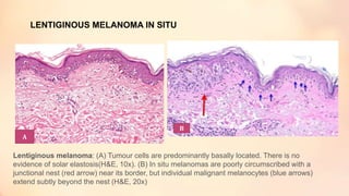 LENTIGINOUS MELANOMA IN SITU
Lentiginous melanoma: (A) Tumour cells are predominantly basally located. There is no
evidence of solar elastosis(H&E, 10x). (B) In situ melanomas are poorly circumscribed with a
junctional nest (red arrow) near its border, but individual malignant melanocytes (blue arrows)
extend subtly beyond the nest (H&E, 20x)
A
B
 