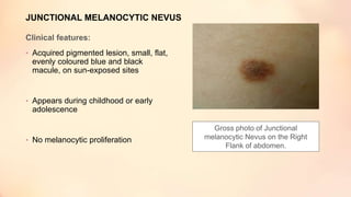 JUNCTIONAL MELANOCYTIC NEVUS
Clinical features:
• Acquired pigmented lesion, small, flat,
evenly coloured blue and black
macule, on sun-exposed sites
• Appears during childhood or early
adolescence
• No melanocytic proliferation
Gross photo of Junctional
melanocytic Nevus on the Right
Flank of abdomen.
 