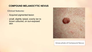 COMPOUND MELANOCYTIC NEVUS
Clinical features:
• Acquired pigmented lesion
• small, slightly raised, evenly tan to
brown coloured, on sun-exposed
skin
Gross photo of Compound Nevus
 
