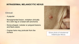 INTRADERMAL MELANOCYTIC NEVUS
Clinical:
• A papular
• Nonpigmented lesion, mistaken clinically
for a skin tag or a basal cell carcinoma
• Dome-shaped, nodular or polypoid lesions
and flesh-colore
• Coarse hairs may protrude from the
surface Gross photo of intradermal
melanocytic Nevus
 
