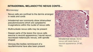 INTRADERMAL MELANOCYTIC NEVUS CONTD…
Microscopy:
• Nevus cells are confined to the dermis arranged
in nests and cords
• Intradermal nevi commonly show intranuclear
pseudoinclusions which are cytoplasmic
invaginations within the nuclei of nevus cells
• Multinucleate nevus cells may be present
• Deeper parts of the lesion the nevus cells
assume a neuroid appearance (‘neural nevus’,
neurotized melanocytic nevus), with spindle
shaped
• Verocay-like bodies reminiscent of a
neurilemmoma have also been present
Intradermal nevus: Some
nevus cell nests have a
neuroid appearance. (H &E,
10x)
 