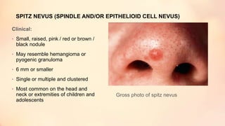 SPITZ NEVUS (SPINDLE AND/OR EPITHELIOID CELL NEVUS)
Clinical:
• Small, raised, pink / red or brown /
black nodule
• May resemble hemangioma or
pyogenic granuloma
• 6 mm or smaller
• Single or multiple and clustered
• Most common on the head and
neck or extremities of children and
adolescents
Gross photo of spitz nevus
 